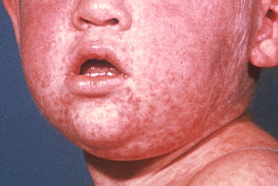 Một trong những triệu chứng mắc sởi là các nốt ban đỏ lan rộng từ mặt, đầu tới toàn thân. 