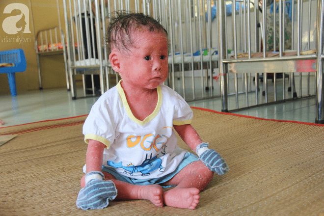 Người đầy vẩy ngứa như da trăn, bé gái 14 tháng tuổi bị bố mẹ bỏ rơi nên không có tiền chữa trị - Ảnh 11.