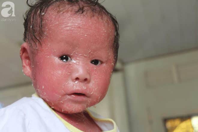 Người đầy vẩy ngứa như da trăn, bé gái 14 tháng tuổi bị bố mẹ bỏ rơi nên không có tiền chữa trị - Ảnh 12.