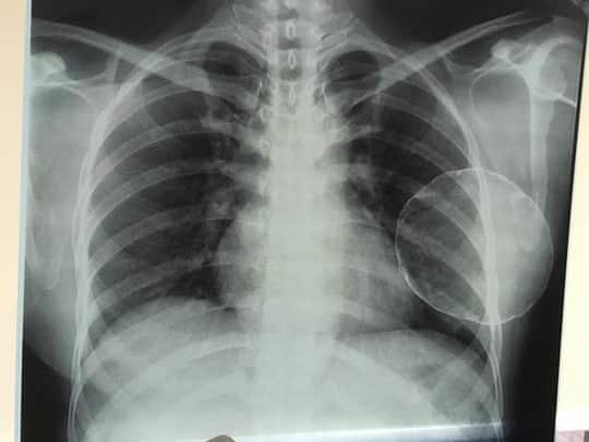 Nâng ngực bị vôi hóa, nữ Việt kiều đau đớn cầu cứu bác sĩ - Ảnh 1.