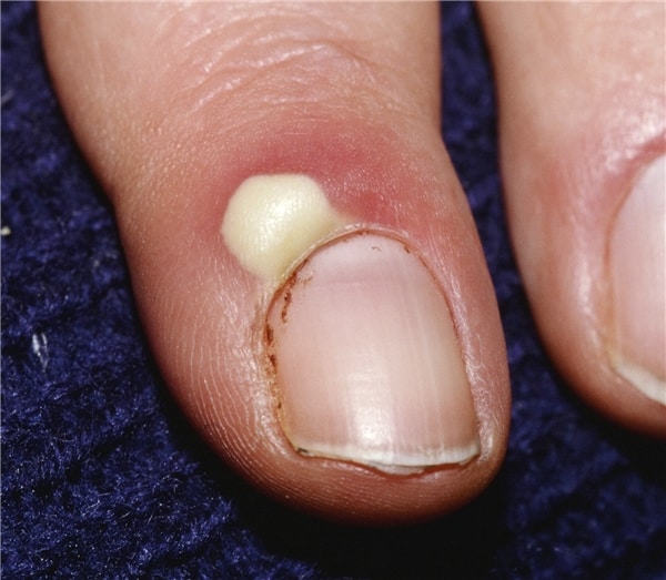 Hội chứng Paronychia ở móng tay.