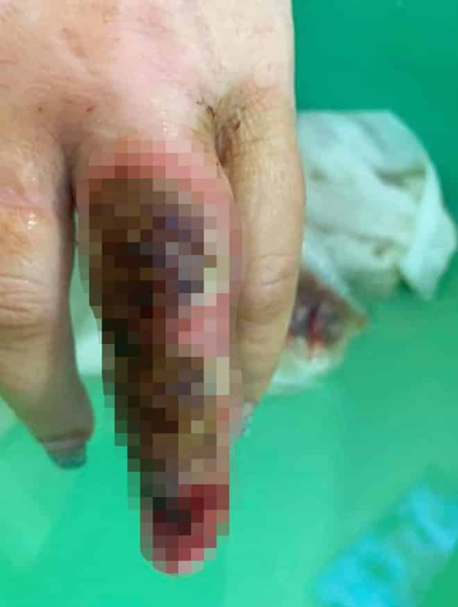 Làm nail ở tiệm quen, người phụ nữ bị hoại tử ngón tay và suýt phải cắt bỏ vì nhiễm trùng - ảnh 1