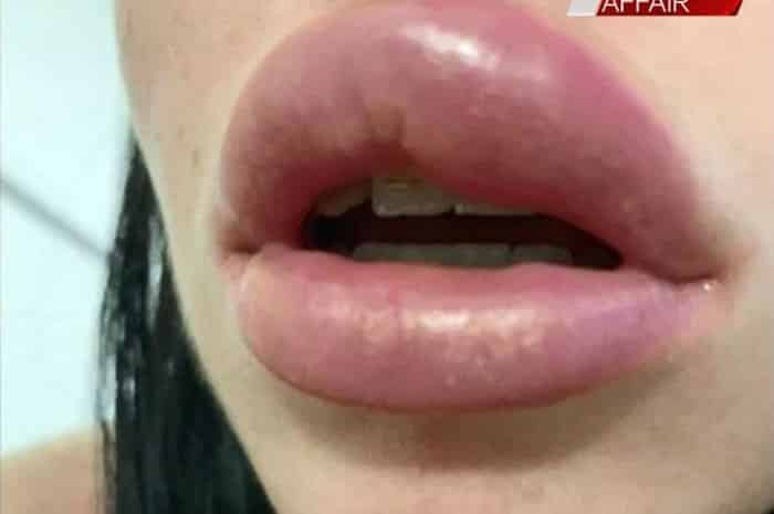  Mikayla Stutchbery, 1 cô gái đến từ Úc gần như đã bị mù sau khi lớp filter tiêm vào môi của cô đã đi vào động mạch khiến môi cô phát nổ.