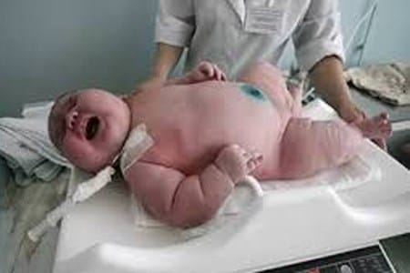 Choáng với em bé sơ sinh nặng 18,2 kg tại Úc