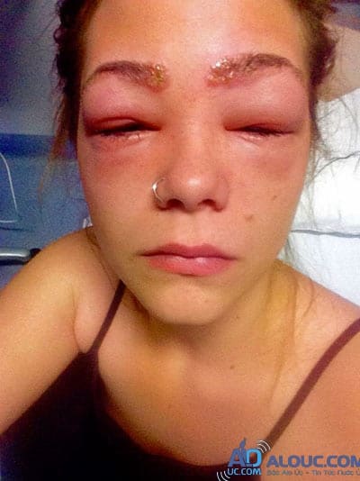 Cô gái suýt mù vì thuốc nhuộm, cảnh báo nguy hiểm cho chị em hay làm đẹp - 2