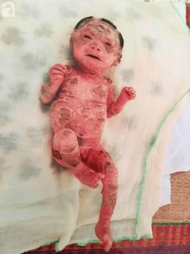 Người đầy vẩy ngứa như da trăn, bé gái 14 tháng tuổi bị bố mẹ bỏ rơi nên không có tiền chữa trị - Ảnh 5.