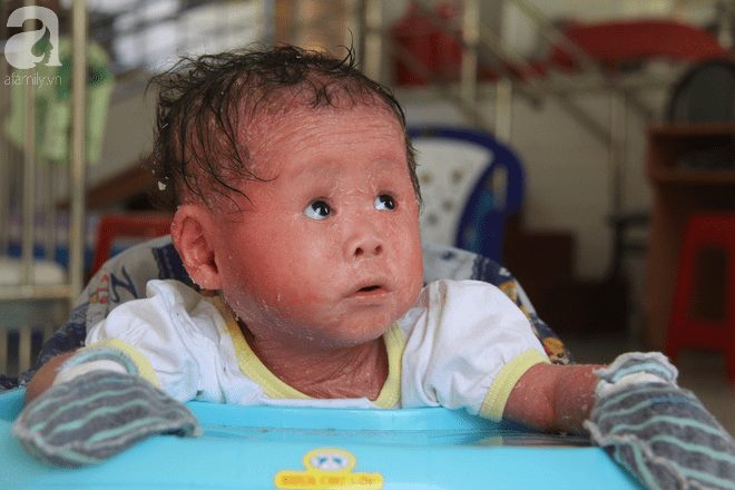 Người đầy vẩy ngứa như da trăn, bé gái 14 tháng tuổi bị bố mẹ bỏ rơi nên không có tiền chữa trị - Ảnh 13.