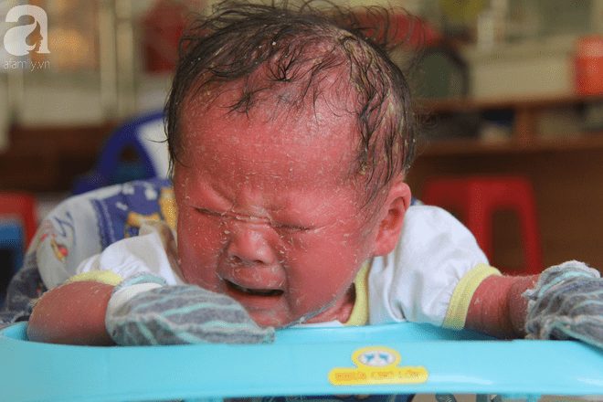 Người đầy vẩy ngứa như da trăn, bé gái 14 tháng tuổi bị bố mẹ bỏ rơi nên không có tiền chữa trị - Ảnh 10.