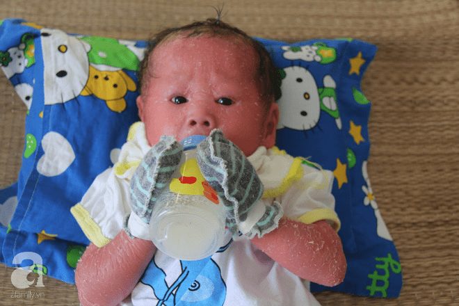 Người đầy vẩy ngứa như da trăn, bé gái 14 tháng tuổi bị bố mẹ bỏ rơi nên không có tiền chữa trị - Ảnh 8.