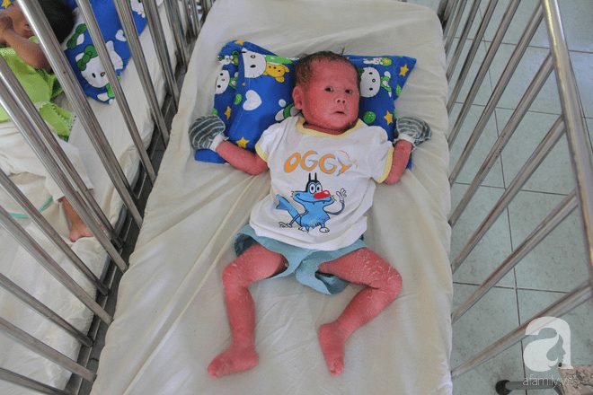 Người đầy vẩy ngứa như da trăn, bé gái 14 tháng tuổi bị bố mẹ bỏ rơi nên không có tiền chữa trị - Ảnh 16.