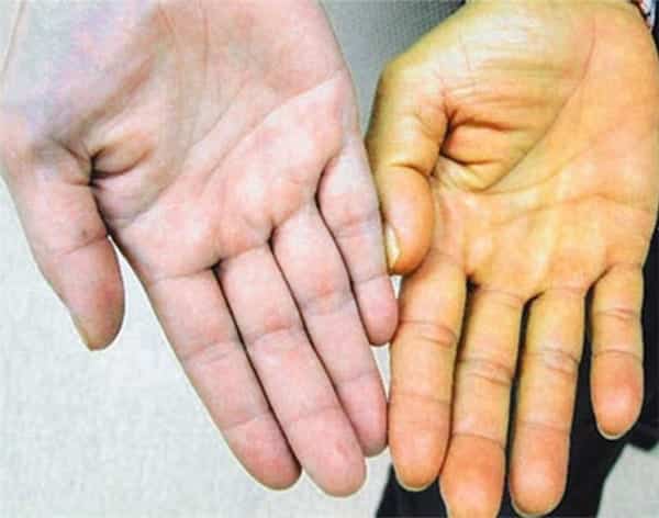  Hãy chú ý đến màu sắc của lòng bàn tay. (Ảnh: Internet)