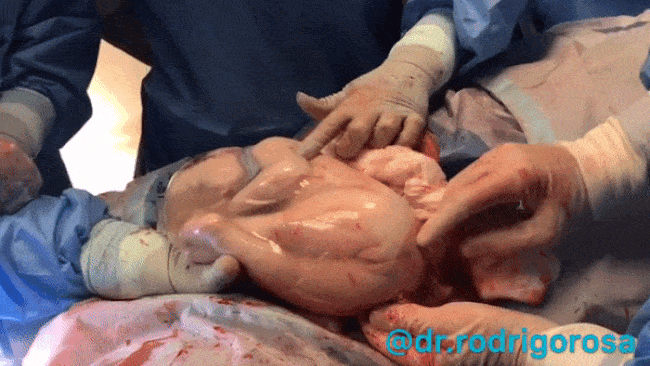 Khoảnh khắc sinh ba diệu kì: 2 trong 3 em bé đã chào đời vẫn yên vị 