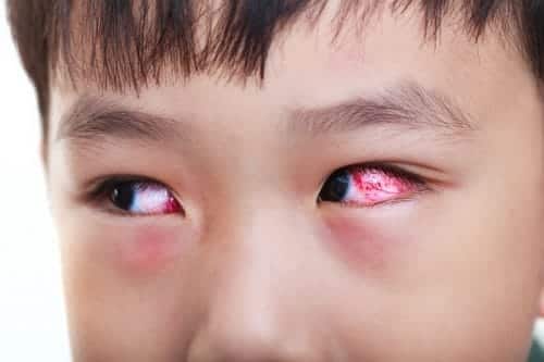 Các phương thuốc tại gia chữa ốm vặt cực hiệu quả 
