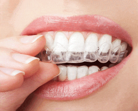 Nghiến răng khi ngủ: Đây là một loại bệnh để lại hậu quả khôn lường, đừng xem thường!