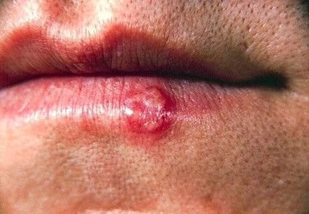 Cảnh giác với hickey: Dấu hôn trên cổ và nguy cơ người yêu bạn tử vong nếu cứ bất chấp để phê