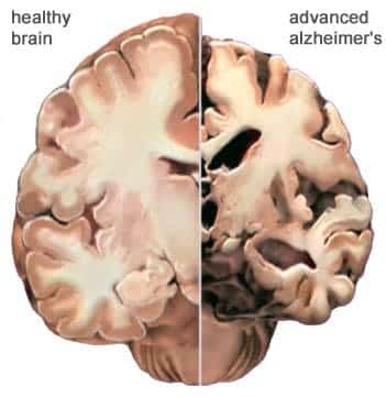  Ngủ đủ giấc khiến bạn không mắc phải chứng Alzheimer.