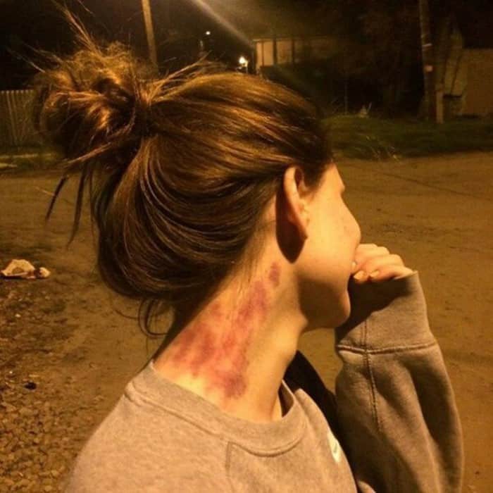 Cảnh giác với hickey: Dấu hôn trên cổ và nguy cơ người yêu bạn tử vong nếu cứ bất chấp để phê