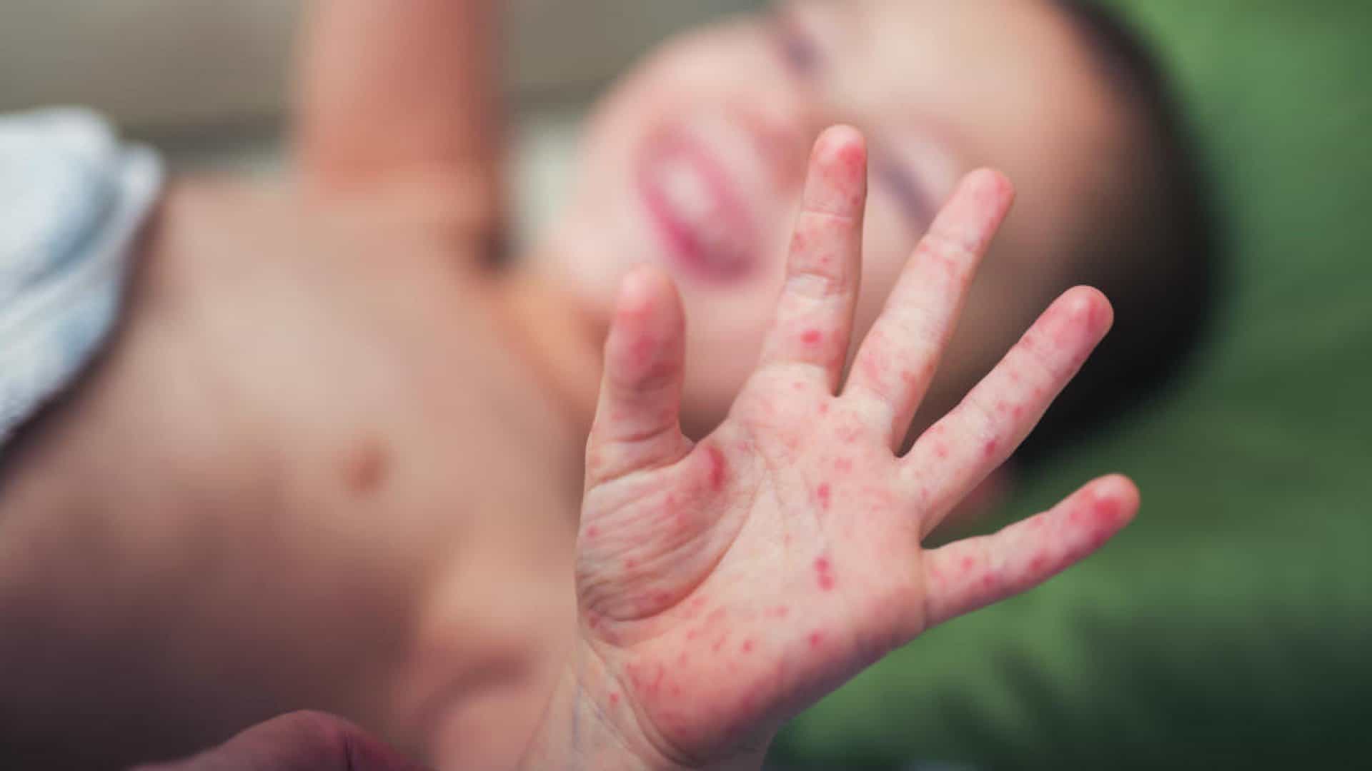 Bệnh tay chân miệng đang vào mùa dịch và dưới đây là những điều mà cả người lớn lẫn trẻ nhỏ đều phải biết - Ảnh 3.