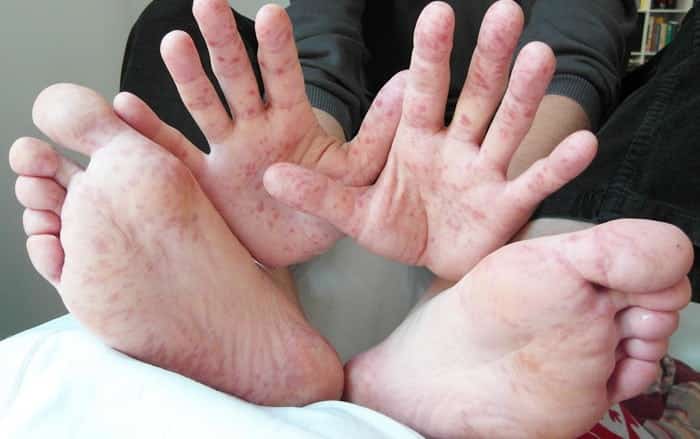 Bệnh tay chân miệng đang vào mùa dịch và dưới đây là những điều mà cả người lớn lẫn trẻ nhỏ đều phải biết - Ảnh 4.