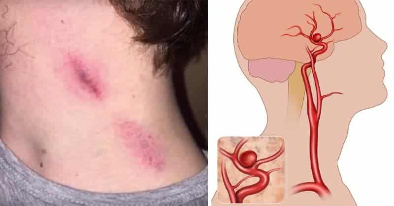 Cảnh giác với hickey: Dấu hôn trên cổ và nguy cơ người yêu bạn tử vong nếu cứ bất chấp để phê