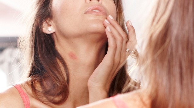 Cảnh giác với hickey: Dấu hôn trên cổ và nguy cơ người yêu bạn tử vong nếu cứ bất chấp để phê