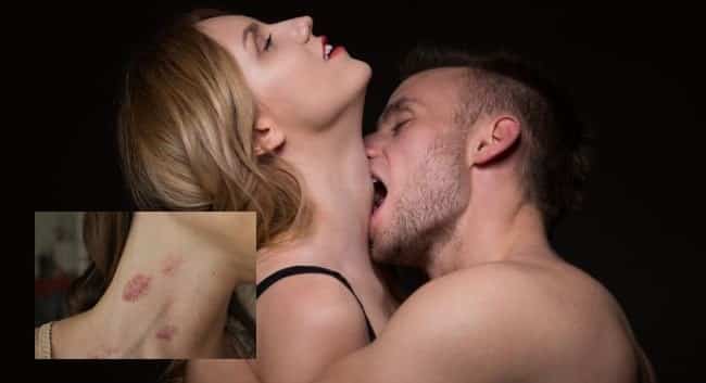 Cảnh giác với hickey: Dấu hôn trên cổ và nguy cơ người yêu bạn tử vong nếu cứ bất chấp để phê