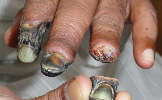 Krokodil khiến người nghiện bị thối rữa và không kiểm soát được hành vi