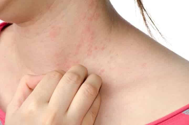 Da bị ngứa, mẩn đỏ cảnh báo vấn đề gì về sức khỏe? - Ảnh 8. Da bị ngứa, mẩn đỏ cảnh báo vấn đề gì về sức khỏe? - Ảnh 8.