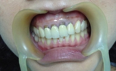 GÓC CẢNH GIÁC: Trào lưu bọc răng, phủ răng sứ và cạm bẫy phía sau những nụ cười công nghiệp