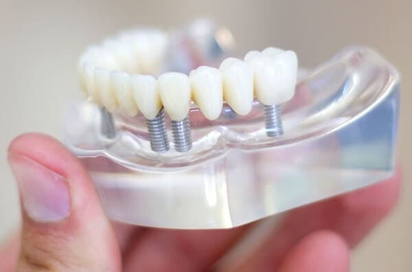  Composite có dạng mềm nhão, dễ tạo hình. Nhưng khi được chiếu ánh sáng, có bước sóng phù hợp, miếng composite sẽ được "quang trùng hợp" và cứng lại. "Công nghệ" trám composite này đã được sử dụng rộng rãi trong ngành nha khoa trên thế giới cũng như ở Việt Nam từ rất lâu. 