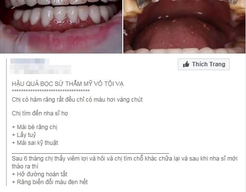 GÓC CẢNH GIÁC: Trào lưu bọc răng, phủ răng sứ và cạm bẫy phía sau những nụ cười công nghiệp