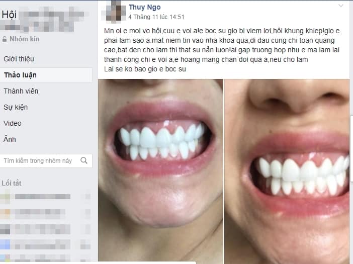 GÓC CẢNH GIÁC: Trào lưu bọc răng, phủ răng sứ và cạm bẫy phía sau những nụ cười công nghiệp