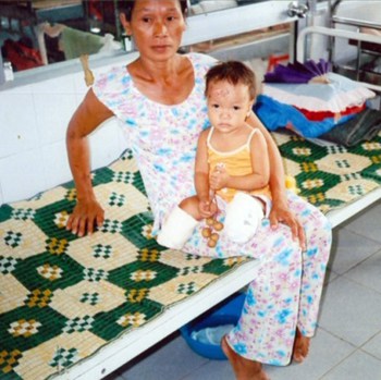 Bé Đỗ Thị Thúy Phượng, sau này là Haven Shepherd, trong bệnh viện sau khi đã phẫu thuật cắt bỏ hai chân. Ảnh: BBC.
