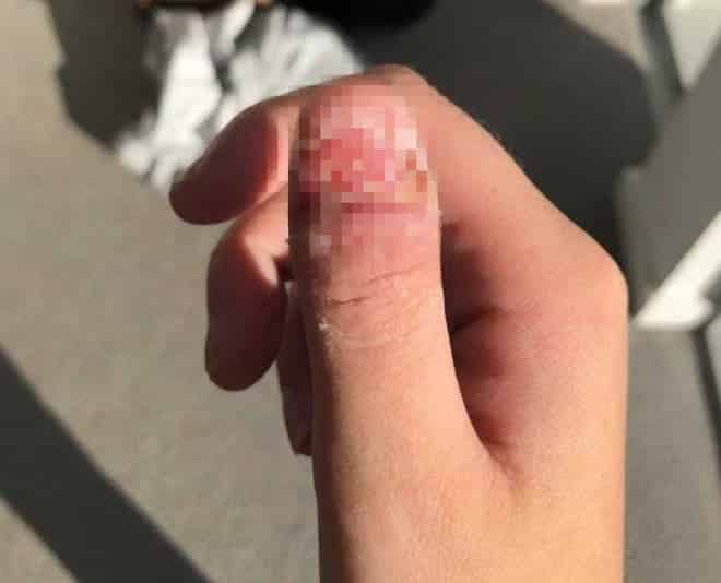Tâm sự của cô gái Úc bị ung thư, phải cắt bỏ ngón tay vì thói quen xấu mà rất nhiều người mắc phải - ảnh 3
