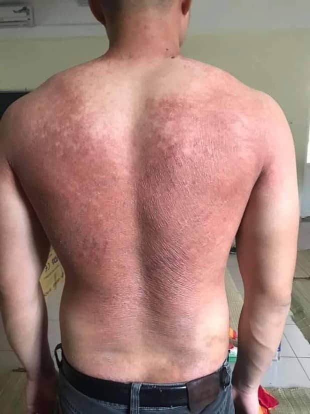 Hình ảnh bác sĩ nơi tâm dịch Bắc Giang khiến nhiều người xót xa: Phía sau lớp áo bảo hộ là tấm lưng cháy nắng phồng rộp - Ảnh 2.