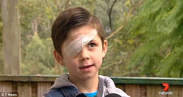 Một bé trai ở bang Queensland bị chim ác là tấn công tổn thương nghiêm trọng mắt phải. Ảnh: DailyMail