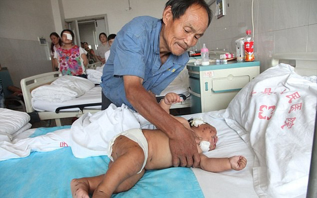 Em bé từng bị mẹ đâm gần 90 nhát kéo vào mặt vì cắn ti khi đang bú khiến dư luận khắp nơi bàng hoàng giờ ra sao? - Ảnh 3.