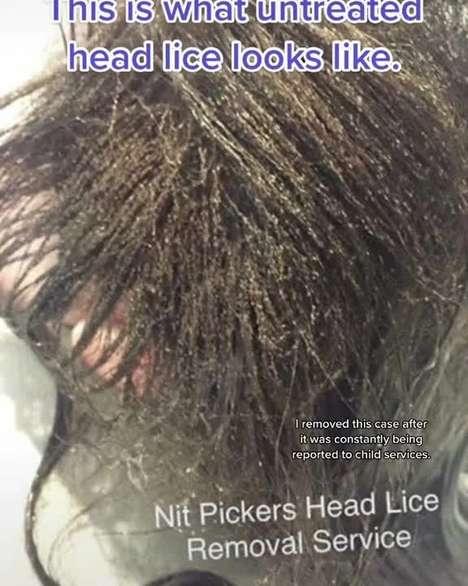 Mang quả đầu đỏ rát, lúc nhúc hàng ngàn con chấy đến salon, cô bé khiến chuyên gia khóc thét vì sốc và kết quả đáng kinh ngạc sau đó - Ảnh 1.