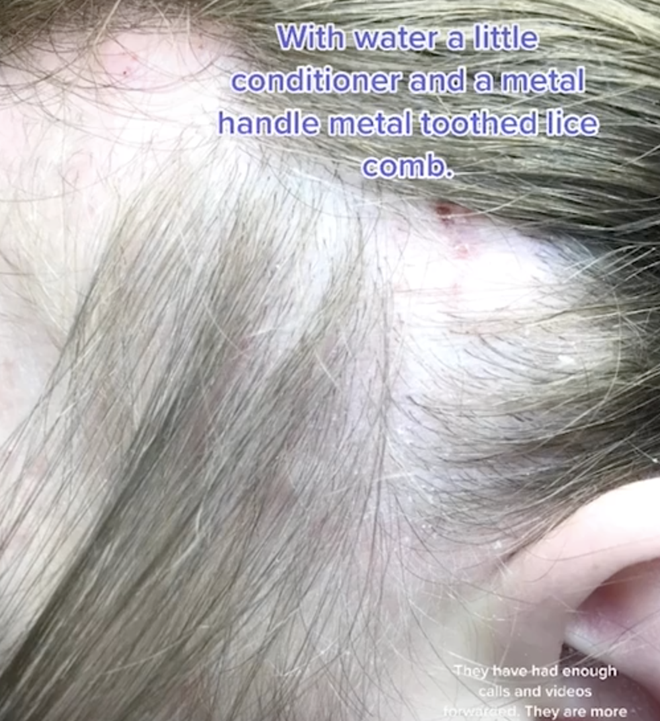 Mang quả đầu đỏ rát, lúc nhúc hàng ngàn con chấy đến salon, cô bé khiến chuyên gia khóc thét vì sốc và kết quả đáng kinh ngạc sau đó - Ảnh 3. Mang quả đầu đỏ rát, lúc nhúc hàng ngàn con chấy đến salon, cô bé khiến chuyên gia khóc thét vì sốc và kết quả đáng kinh ngạc sau đó - Ảnh 3.