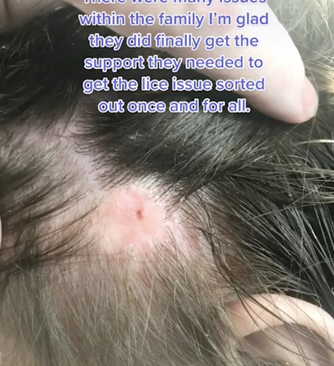 Mang quả đầu đỏ rát, lúc nhúc hàng ngàn con chấy đến salon, cô bé khiến chuyên gia khóc thét vì sốc và kết quả đáng kinh ngạc sau đó - Ảnh 3.