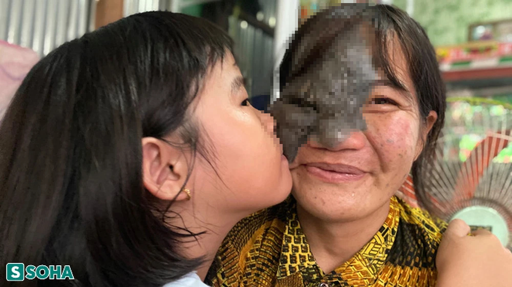 Cuộc đời buồn của người mẹ mặt quỷ và món quà vô giá trời ban - Ảnh 3.