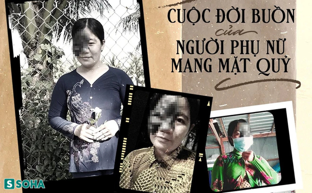 Cuộc đời buồn của 'người mẹ mặt quỷ' và món quà vô giá trời ban