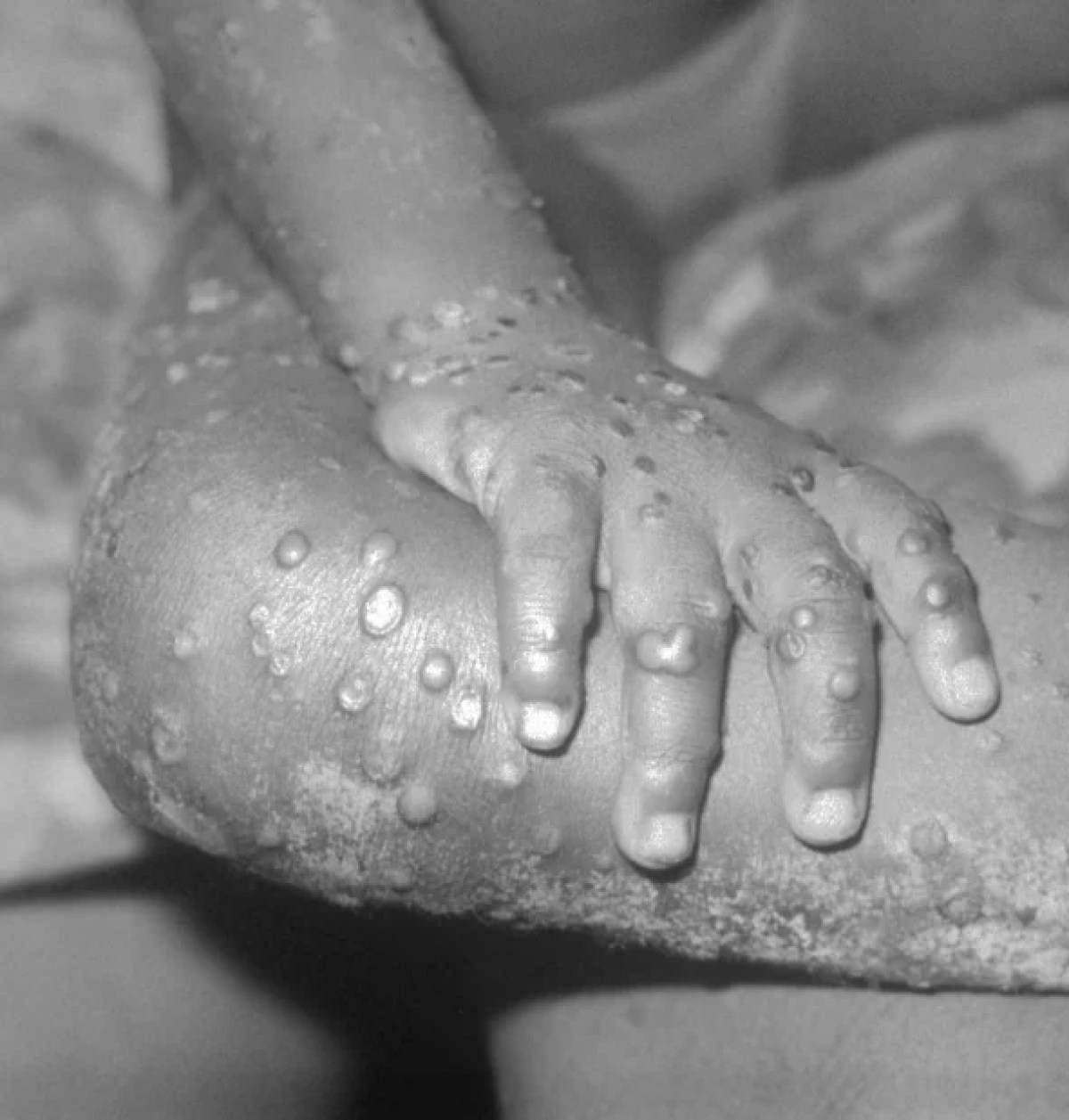 Mụn nổi trên người một bệnh nhân mắc bệnh đậu mùa khỉ. Nguồn: CDC Mỹ