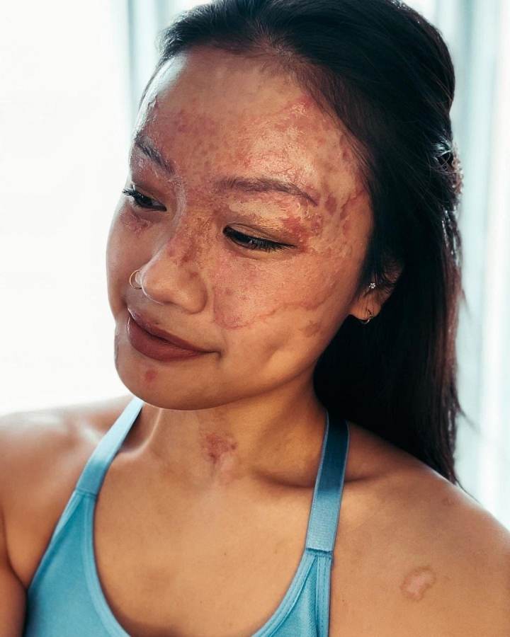 Cô gái bị hủy hoại mặt vì sơ suất từ bạn trai: Hành trình chữa lành đầy nước mắt - 6