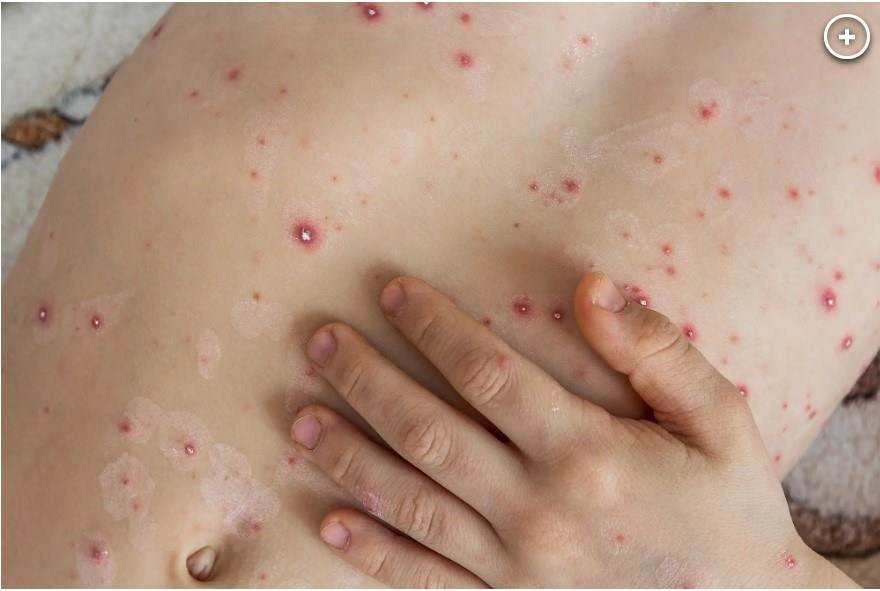 "Cúm cà chua" - bệnh bí ẩn đang bùng phát ở Ấn Độ